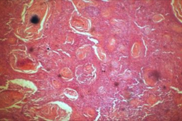 Skin Cancer