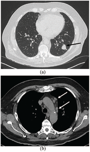 Lung cancer CT scan for British elderly male