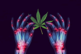 Arthritis patient X-Ray of hands, showing medical marijuana and medical cannabis helps ease pain